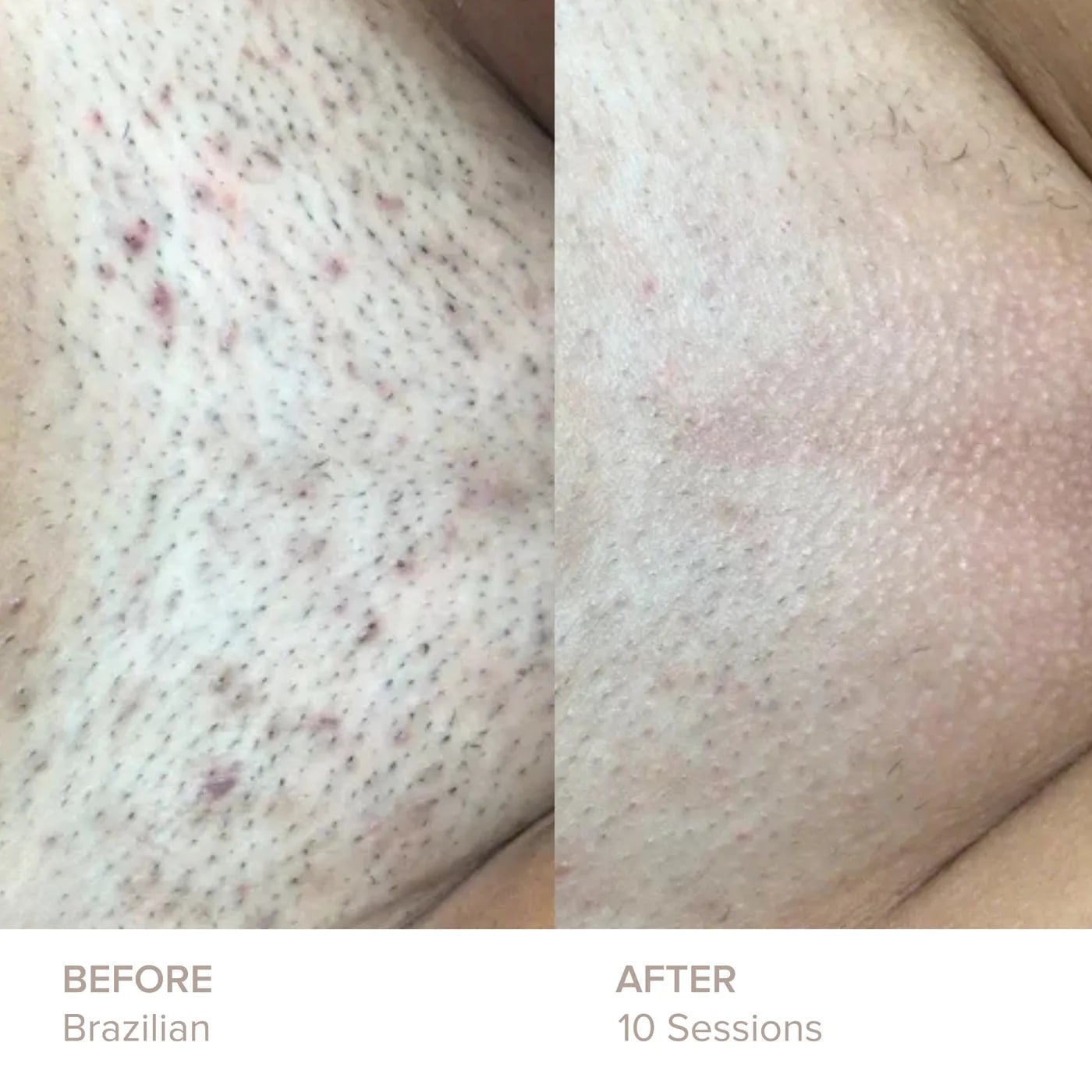Brazilian before and after 10 sessions of laser hair removal at Semper Laser