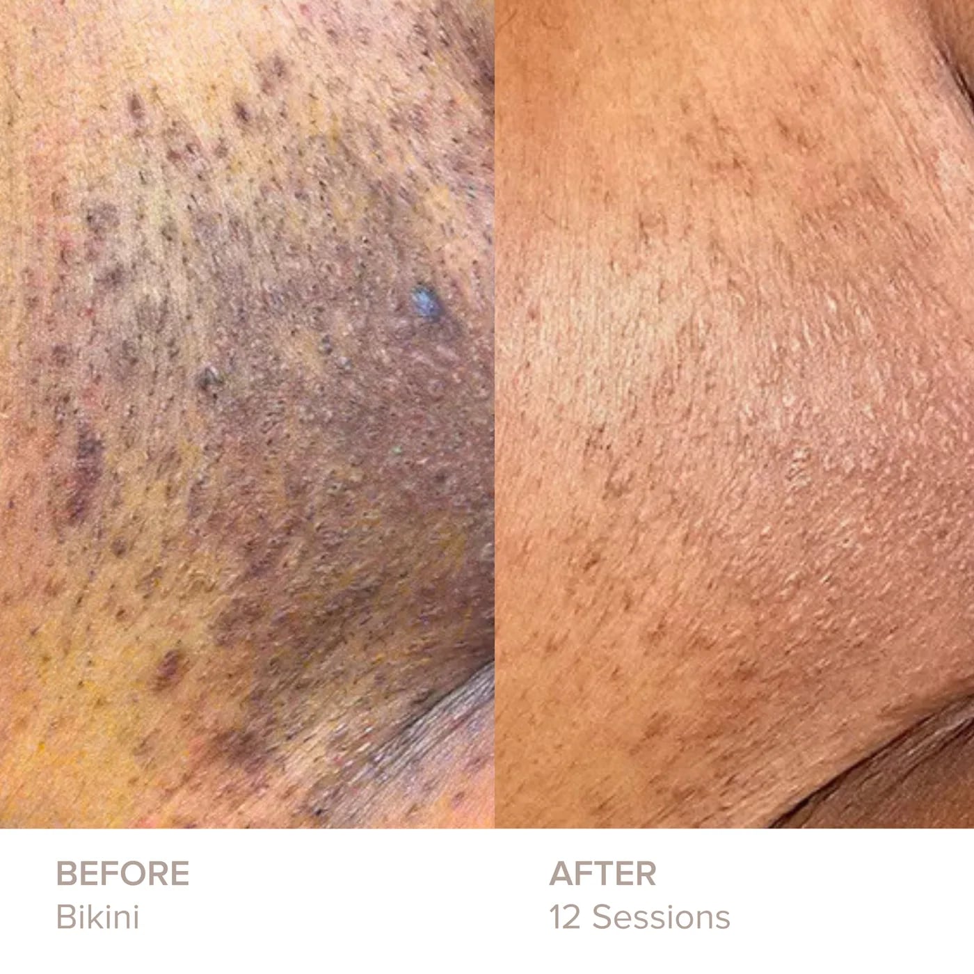 Bikini before and after 12 sessions of laser hair removal at Semper Laser