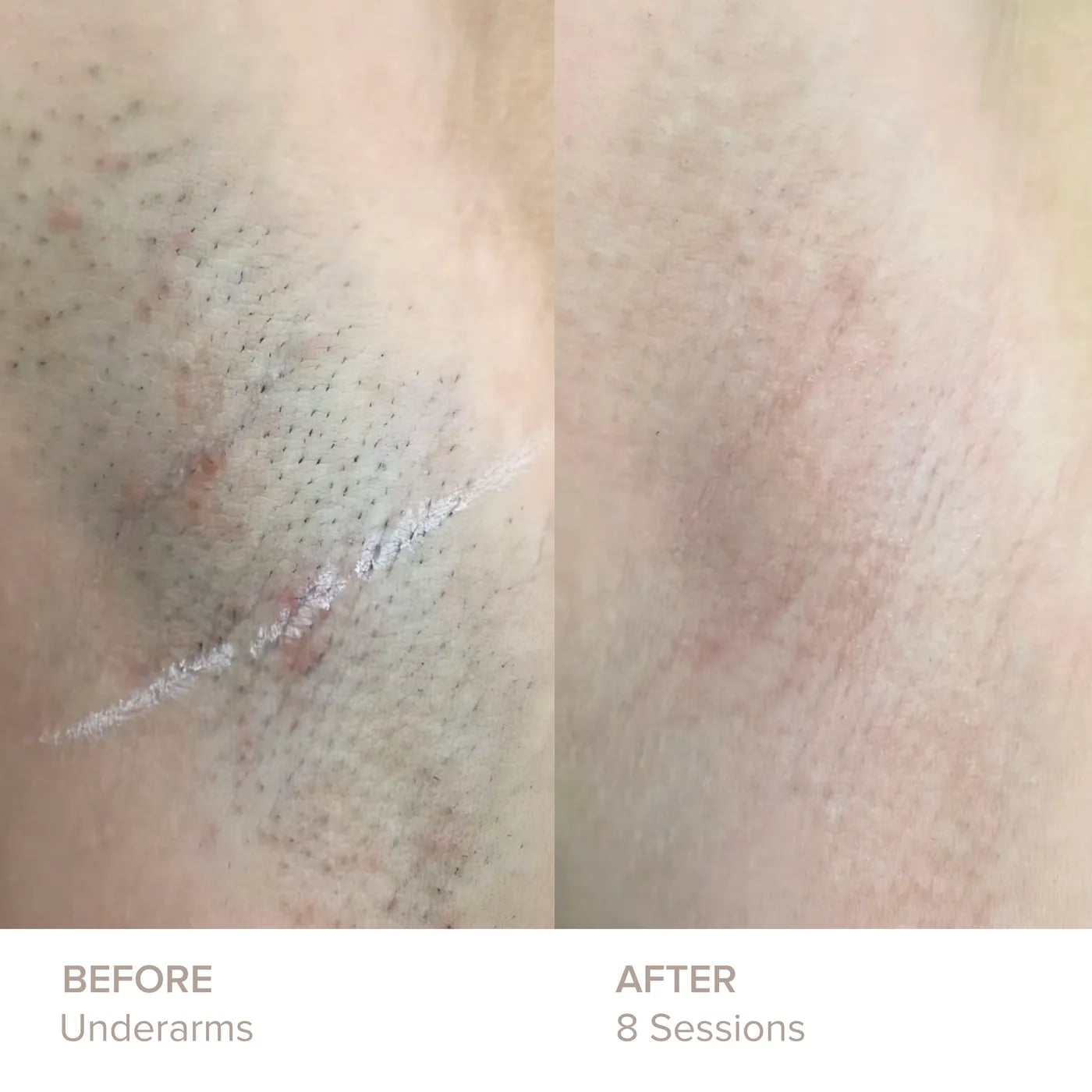 Underarms before and after 8 sessions of laser hair removal at Semper Laser