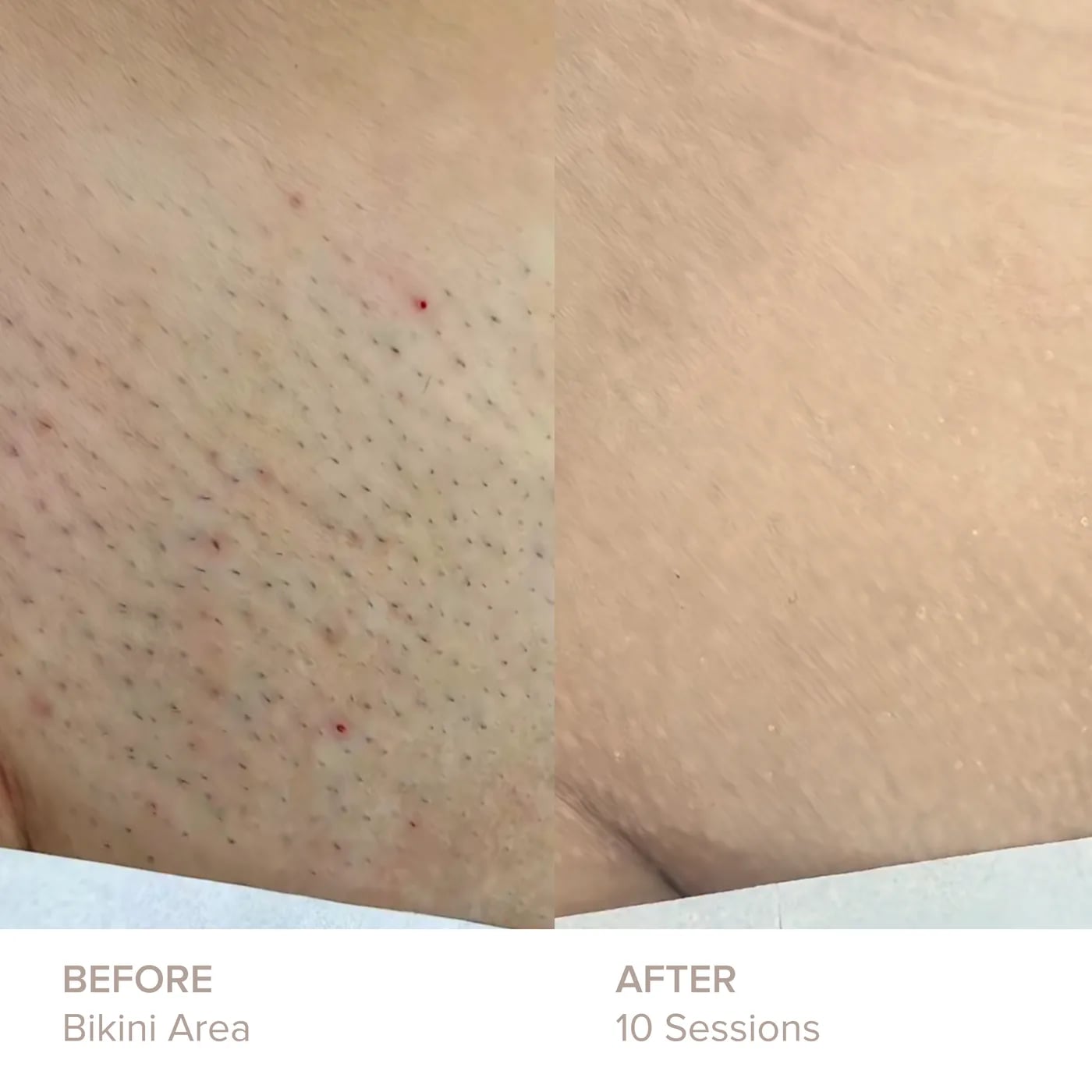 Bikini Area before and after 10 sessions of laser hair removal at Semper Laser