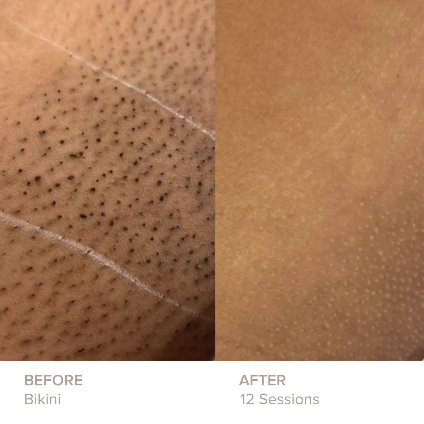 Bikini before and after 12 sessions of laser hair removal at Semper Laser